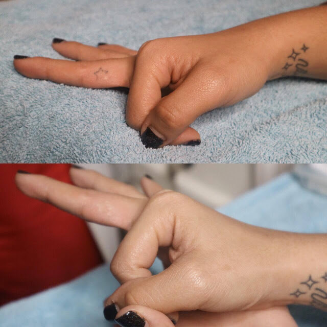 PicoWay Tattoo Removal Before and After